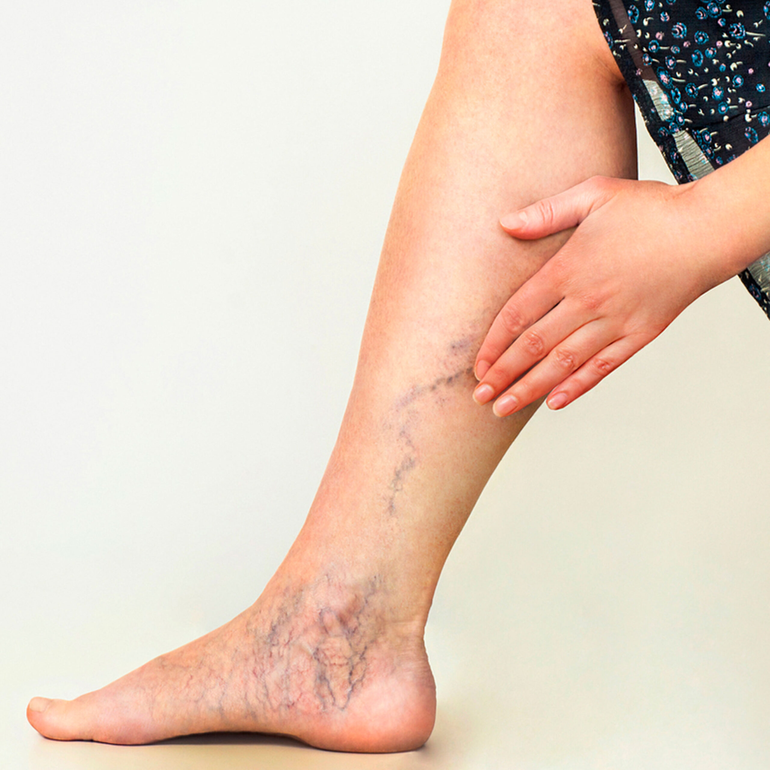 Várices y arañitas, la importancia de atenderse a tiempo