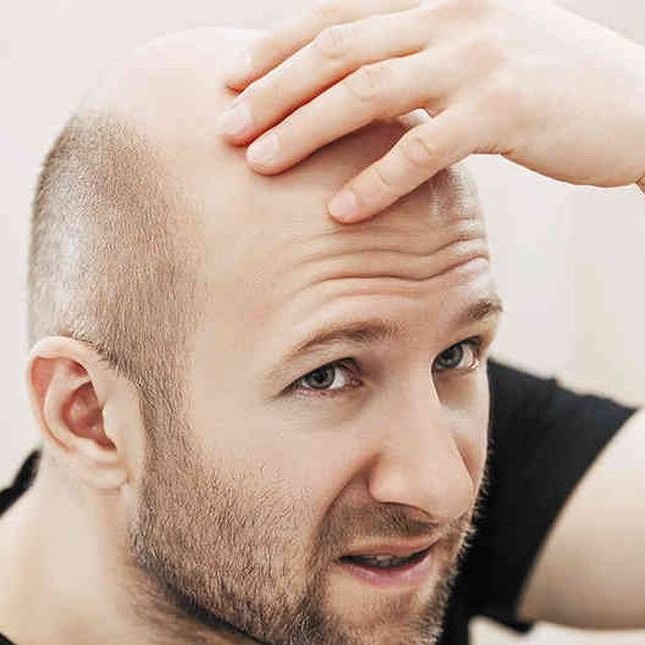 Calvicie: ¿por qué se cae el pelo?